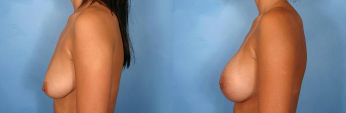 Before & After Breast Augmentation with Lift Case 73 View #2 View in Naples and Ft. Myers, FL