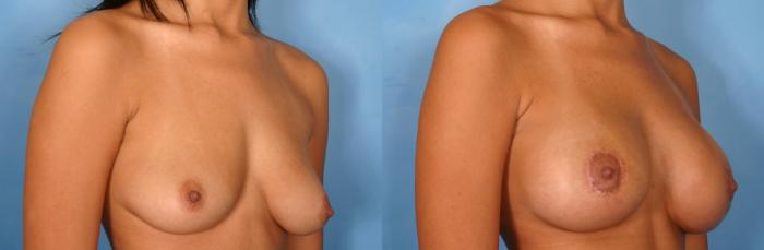 Before & After Breast Augmentation with Lift Case 73 View #3 View in Naples and Ft. Myers, FL