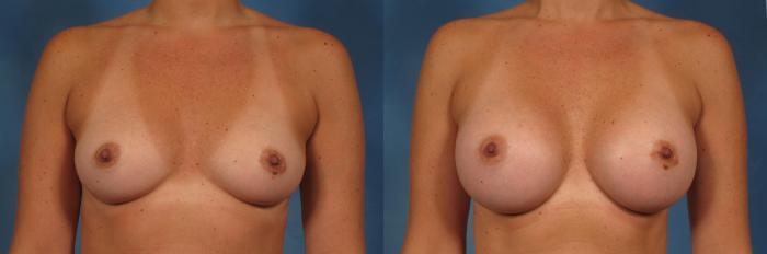 Before & After Breast Augmentation with Shaped Breast Implants Case 241 View #1 View in Naples and Ft. Myers, FL