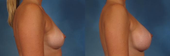 Before & After Breast Augmentation with Shaped Breast Implants Case 241 View #2 View in Naples and Ft. Myers, FL