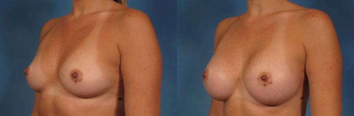 Before & After Breast Augmentation with Shaped Breast Implants Case 241 View #3 View in Naples and Ft. Myers, FL