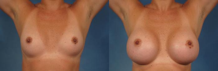 Before & After Breast Augmentation with Shaped Breast Implants Case 241 View #4 View in Naples and Ft. Myers, FL