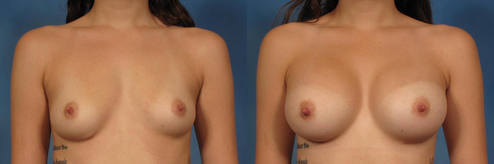 Before & After Breast Augmentation with Shaped Breast Implants Case 256 View #1 View in Naples and Ft. Myers, FL