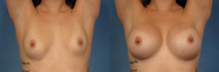 Before & After Breast Augmentation with Shaped Breast Implants Case 256 View #4 View in Naples and Ft. Myers, FL
