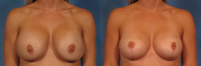 Before & After Breast Augmentation with Shaped Breast Implants Case 277 View #1 View in Naples and Ft. Myers, FL