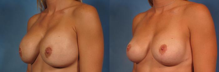 Before & After Breast Augmentation with Shaped Breast Implants Case 277 View #4 View in Naples and Ft. Myers, FL