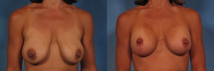 Before & After Breast Augmentation with Shaped Breast Implants Case 278 View #1 View in Naples and Ft. Myers, FL