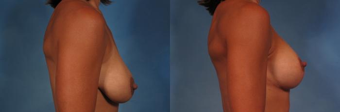 Before & After Breast Augmentation with Shaped Breast Implants Case 278 View #2 View in Naples and Ft. Myers, FL