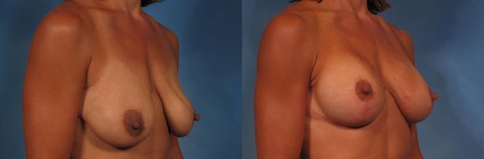 Before & After Breast Augmentation with Shaped Breast Implants Case 278 View #3 View in Naples and Ft. Myers, FL