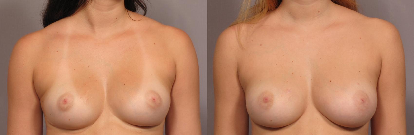 Before Breast Augmentation with Fat Grafting, Front View