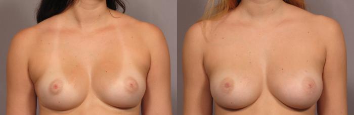 Before Breast Augmentation with Fat Grafting, Front View