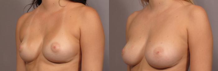 Before Breast Augmentation with Fat Grafting, Left Oblique View