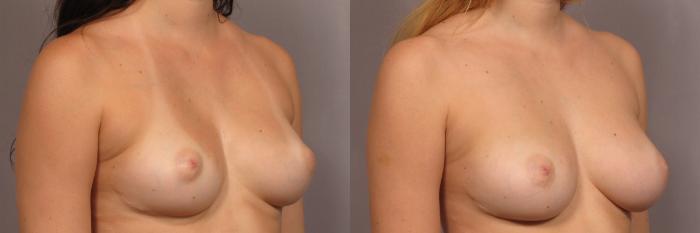 Before Breast Augmentation with Fat Grafting, Right Oblique View