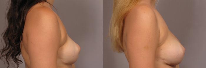 Before Breast Augmentation with Fat Grafting, Right Side View