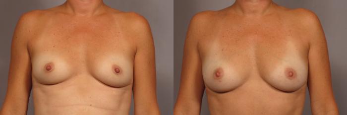 Before Breast Augmentation with Fat Grafting, Front View
