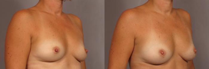 Before Breast Augmentation with Fat Grafting, Right Oblique View