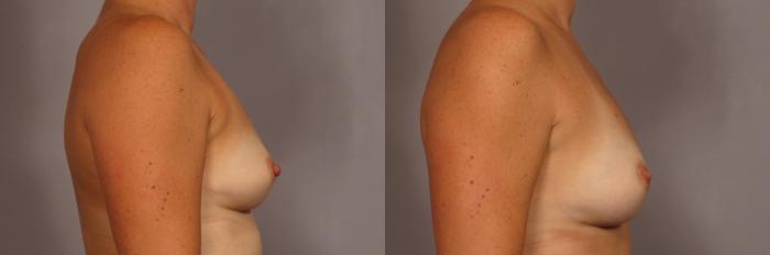 Before Breast Augmentation with Fat Grafting, Right Side View