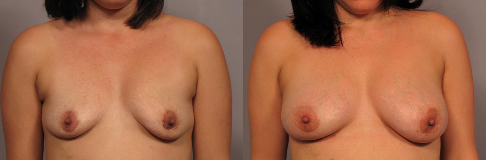 Before Breast Augmentation with Fat Grafting, front view