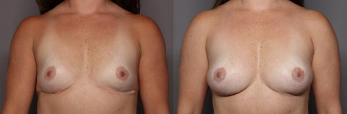 Before Breast Augmentation with Fat Grafting, Front View