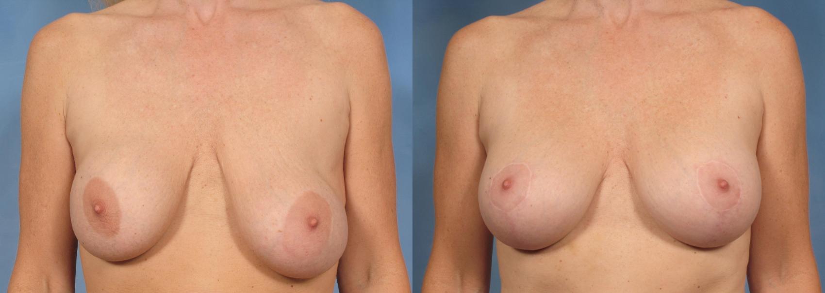 乳房植入物交换/翻修前后病例131视图1那不勒斯和佛罗里达州迈尔斯堡的视图