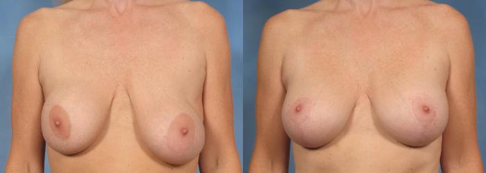 Before & After Breast Implant Exchange/Revision Case 131 View #1 View in Naples and Ft. Myers, FL