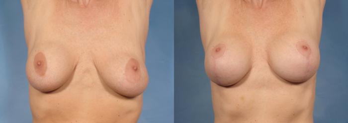 Before & After Breast Implant Exchange/Revision Case 131 View #2 View in Naples and Ft. Myers, FL