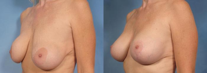 Before & After Breast Implant Exchange/Revision Case 131 View #3 View in Naples and Ft. Myers, FL