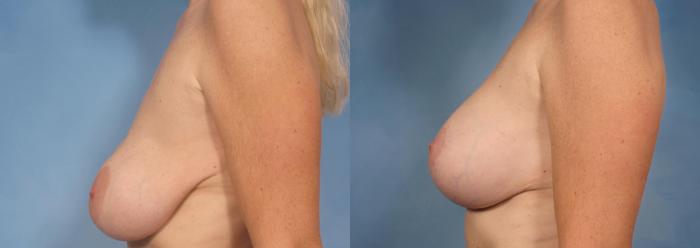 Before & After Breast Implant Exchange/Revision Case 131 View #4 View in Naples and Ft. Myers, FL