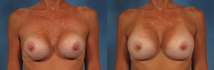 Before & After Breast Implant Exchange/Revision Case 168 View #1 View in Naples and Ft. Myers, FL