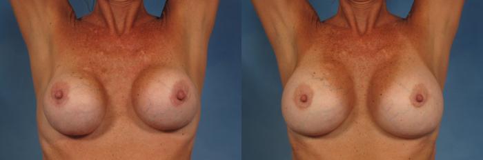 Before & After Breast Implant Exchange/Revision Case 168 View #2 View in Naples and Ft. Myers, FL