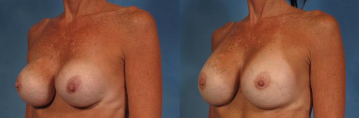 Before & After Breast Implant Exchange/Revision Case 168 View #3 View in Naples and Ft. Myers, FL