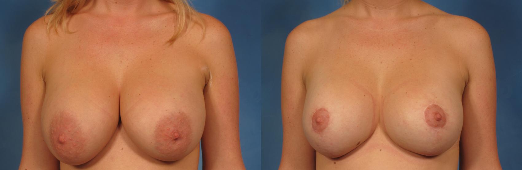 Before & After Breast Implant Exchange/Revision Case 229 View #1 View in Naples and Ft. Myers, FL