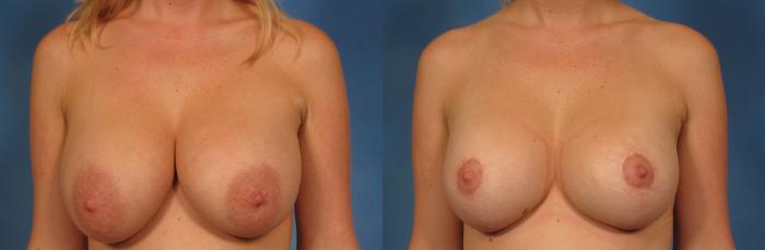 Before & After Breast Implant Exchange/Revision Case 229 View #1 View in Naples and Ft. Myers, FL