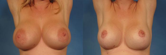 Before & After Breast Implant Exchange/Revision Case 229 View #2 View in Naples and Ft. Myers, FL
