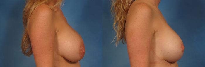 Before & After Breast Implant Exchange/Revision Case 229 View #4 View in Naples and Ft. Myers, FL