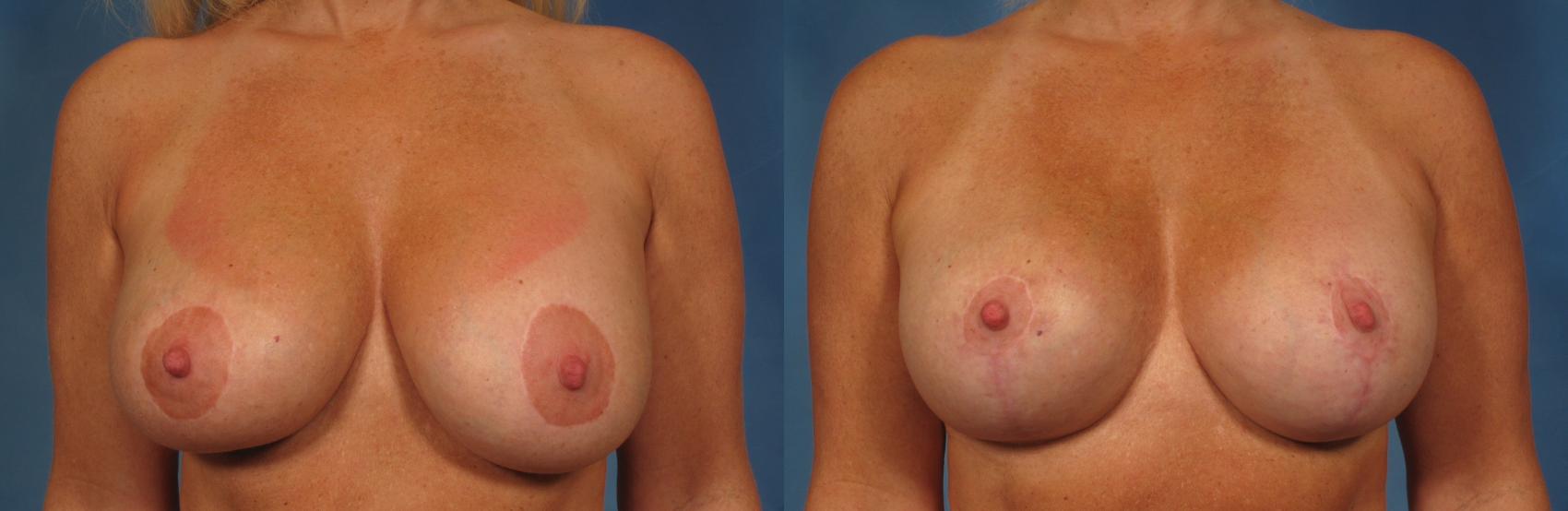 Before & After Breast Implant Exchange/Revision Case 261 View #1 View in Naples and Ft. Myers, FL