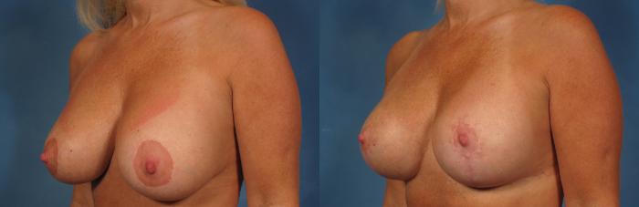 Before & After Breast Implant Exchange/Revision Case 261 View #2 View in Naples and Ft. Myers, FL