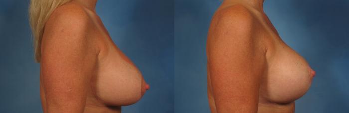 Before & After Breast Implant Exchange/Revision Case 261 View #3 View in Naples and Ft. Myers, FL