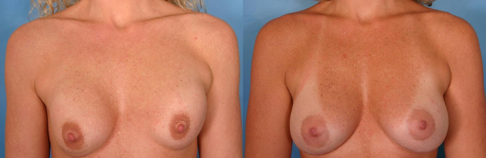 Before & After Breast Implant Exchange/Revision Case 31 View #1 View in Naples and Ft. Myers, FL