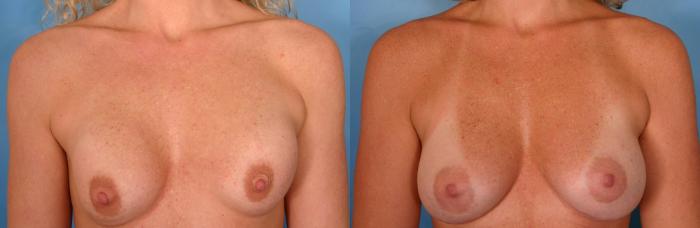 Before & After Breast Implant Exchange/Revision Case 31 View #1 View in Naples and Ft. Myers, FL