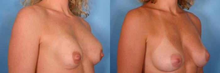 Before & After Breast Implant Exchange/Revision Case 31 View #2 View in Naples and Ft. Myers, FL