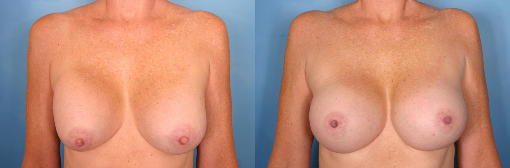 Before & After Breast Implant Exchange/Revision Case 32 View #1 View in Naples and Ft. Myers, FL