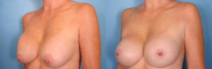 Before & After Breast Implant Exchange/Revision Case 32 View #2 View in Naples and Ft. Myers, FL