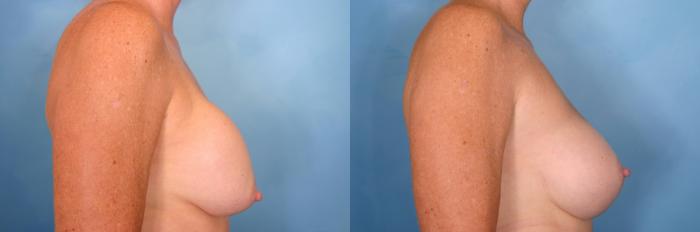 Before & After Breast Implant Exchange/Revision Case 32 View #3 View in Naples and Ft. Myers, FL