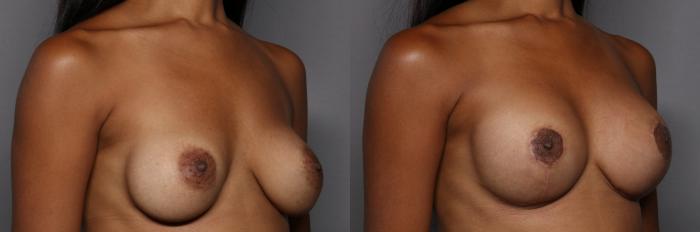 Right Oblique view of Breast Implant Exchange with Breast Lift