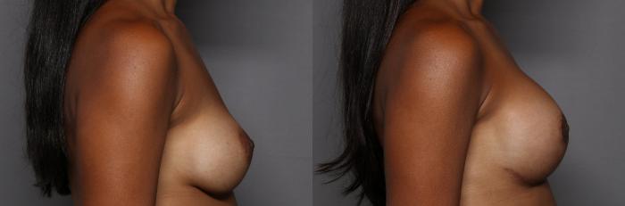 Right Side view of Before andAfter Breast Implant Exchange with Breast Lift