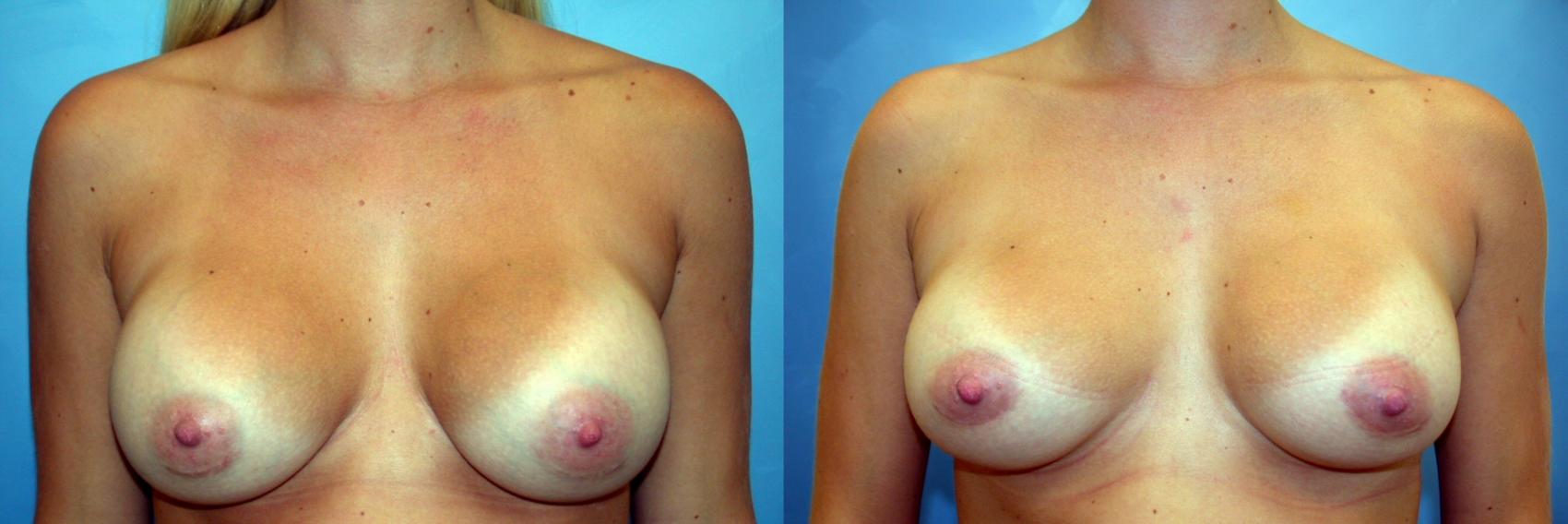 Before & After Breast Implant Exchange/Revision Case 45 View #1 View in Naples and Ft. Myers, FL