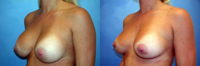 Before & After Breast Implant Exchange/Revision Case 45 View #2 View in Naples and Ft. Myers, FL