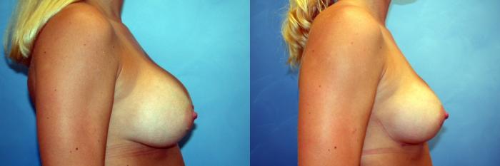 Before & After Breast Implant Exchange/Revision Case 45 View #3 View in Naples and Ft. Myers, FL