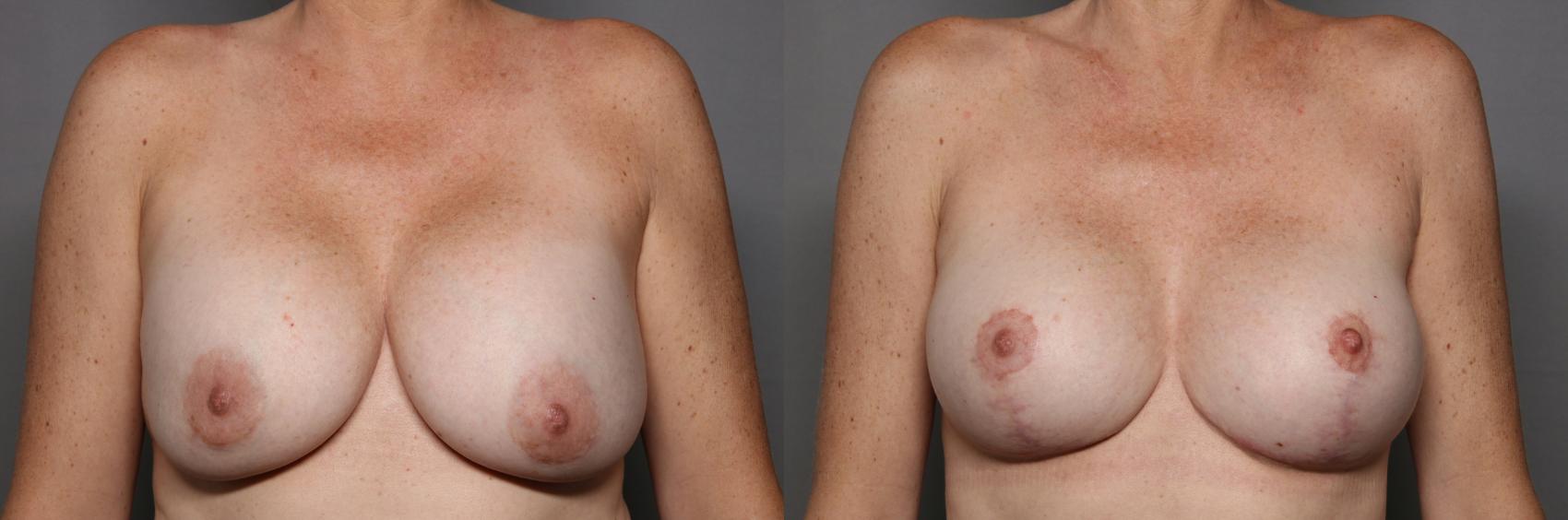 Before Breast Implant Exchange with Lift, Front View